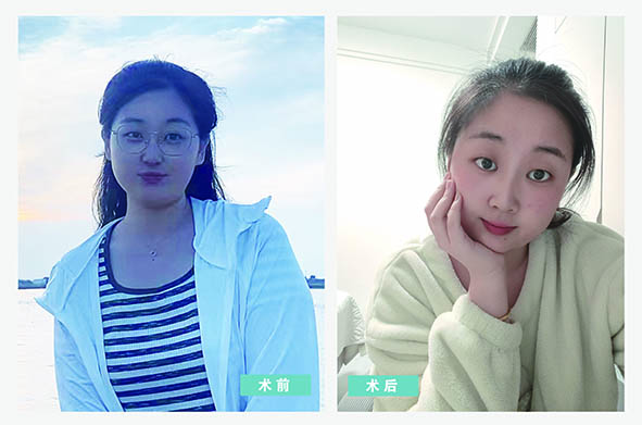 营口何氏眼科医院员工摘镜日记   第八期